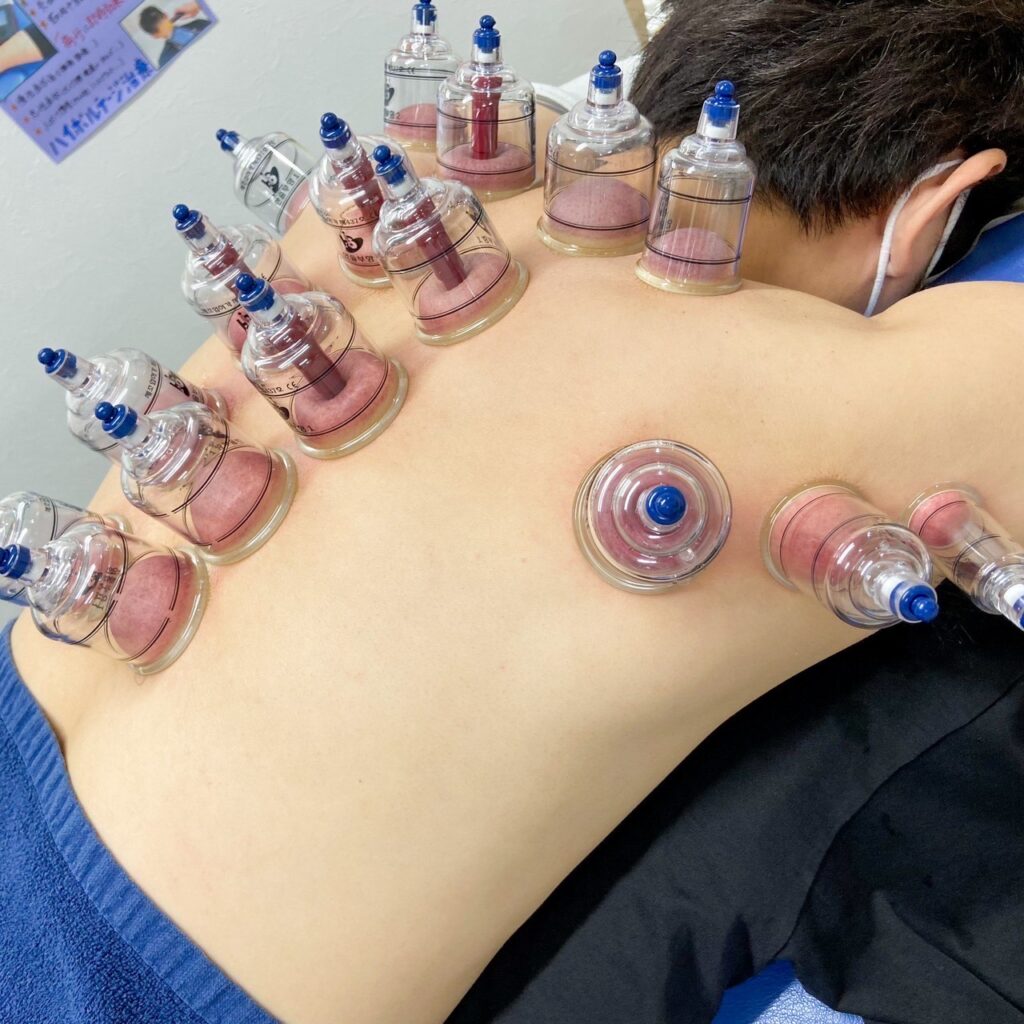 足の吸玉（カッピング）の効果✨